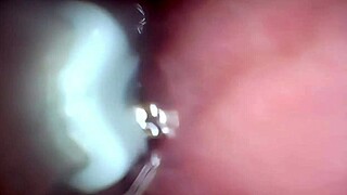 Watch Semen Blast Deep into Cervix Through Wide Stretched Pussy Endoscope!